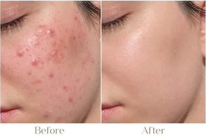 How to Treat Acne at Home in Delhi Without Making It Worse