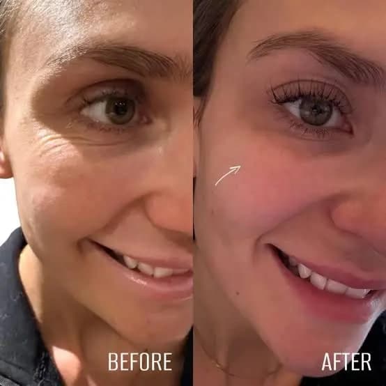 Salmon DNA Skin Boosters Explained: Is Polynucleotide Treatment Worth the Hype?